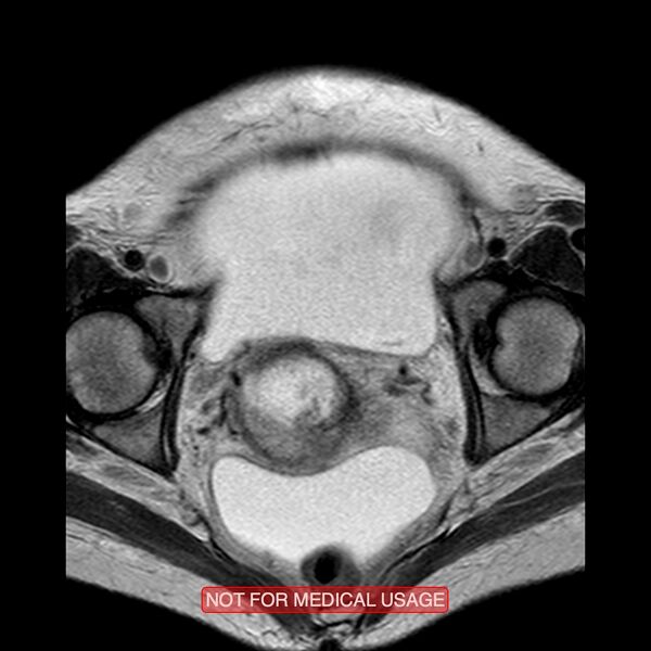 File:Adenocarcinoma of the cervix (Radiopaedia 28373-28615 Axial T2 8).jpg