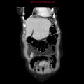Adenocarcinoma of the colon (Radiopaedia 8191-9039 Coronal liver window 9).jpg