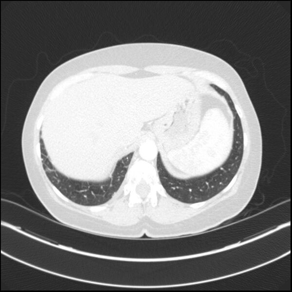 File:Adenocarcinoma of the lung (Radiopaedia 44205-47803 Axial lung window 79).jpg