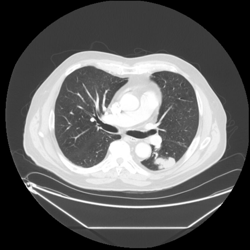 Adenocarcinoma of the lung (Radiopaedia 44876-48759 Axial lung window 36).jpg