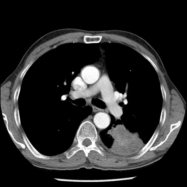 File:Adenocarcinoma of the lung - micropapillary predominant (Radiopaedia 42446-45563 Axial C+ portal venous phase 31).jpg