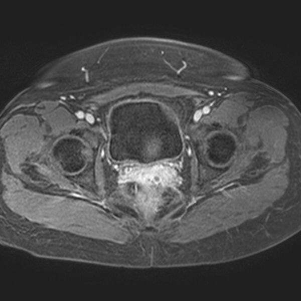 File:Adenomyoma of the uterus (Radiopaedia 9871-10439 Axial T1 C+ fat sat 7).jpg