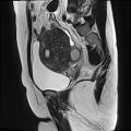 Adenomyosis - ovarian endometriomas (Radiopaedia 67031-76350 Sagittal T2 17).jpg
