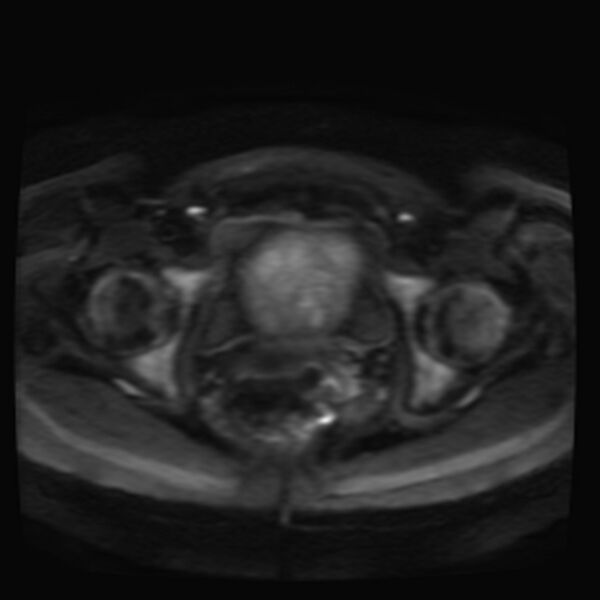 File:Adenomyosis on MRI (Radiopaedia 29328-29780 Axial DWI 11).jpg