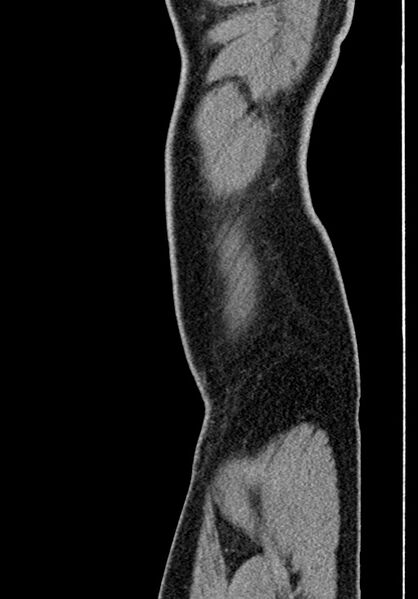 File:Adhesional small bowel obstruction (Radiopaedia 58900-66131 Sagittal C+ portal venous phase 245).jpg