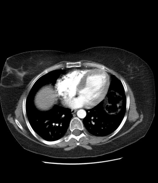 File:Adrenal cortical carcinoma with IVC invasion and thrombosis (Radiopaedia 34307-35597 Axial C+ arterial phase 4).jpg