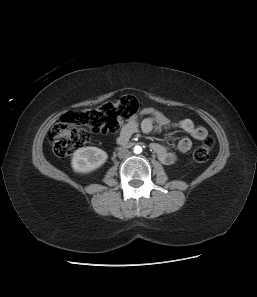 File:Adrenal cortical carcinoma with IVC invasion and thrombosis (Radiopaedia 34307-35597 Axial C+ arterial phase 47).jpg