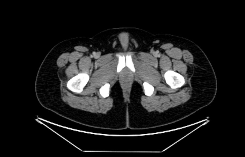 Adrenocortical carcinoma (Radiopaedia 80134-93438 Axial C+ portal venous phase 138).jpg