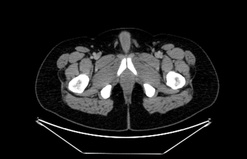 Adrenocortical carcinoma (Radiopaedia 80134-93438 Axial C+ portal venous phase 139).jpg