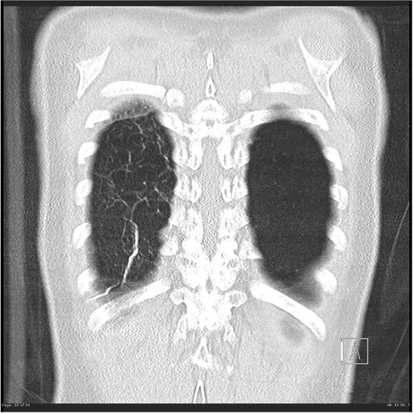 File:Alpha-1-antitrypsin deficiency (Radiopaedia 26537-26678 Coronal lung window 32).jpg