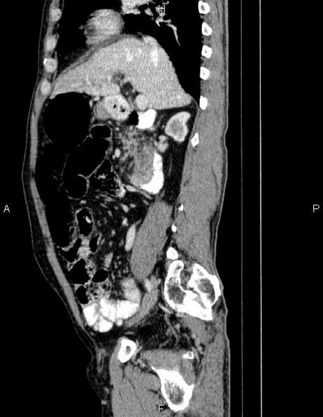 File:Ampullary adenocarcinoma (Radiopaedia 86093-102032 D 35).jpg