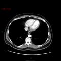 Ampullary carcinoma (Radiopaedia 56396-63056 B 9).jpg