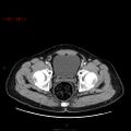Ampullary carcinoma (Radiopaedia 56396-63056 C 95).jpg