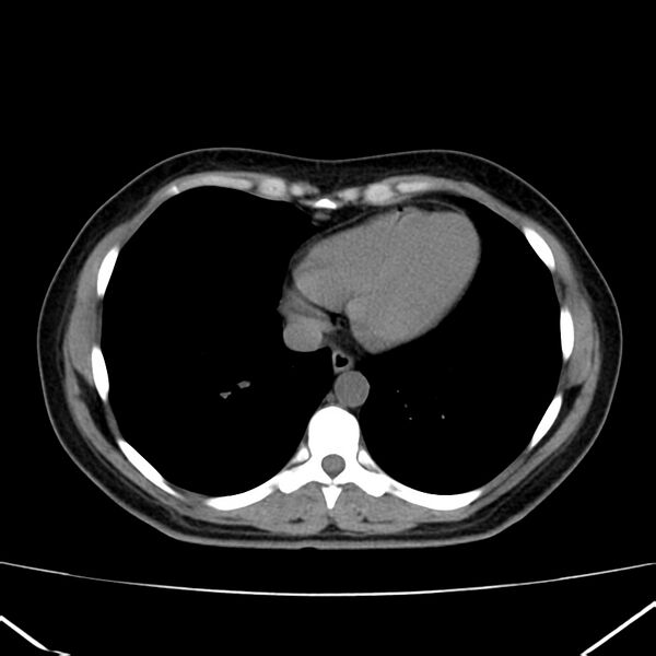 File:Ampullary tumor (Radiopaedia 22787-22816 Axial non-contrast 1).jpg