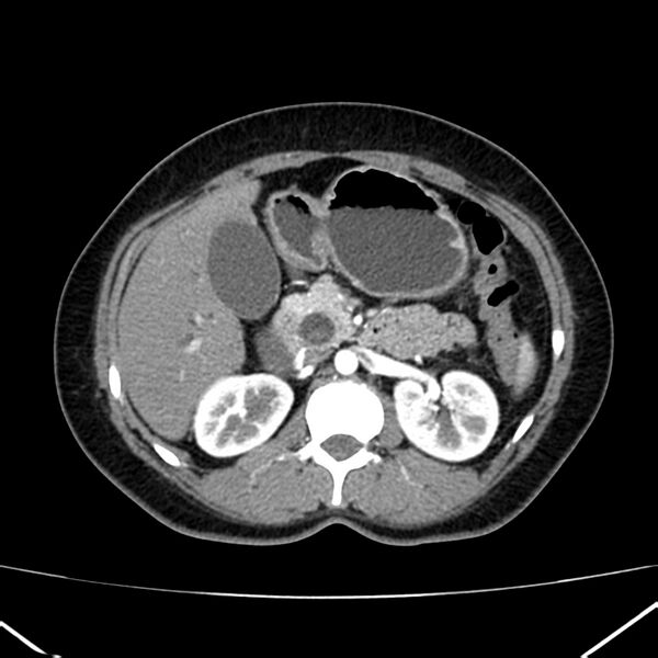 File:Ampullary tumor (Radiopaedia 22787-22816 B 34).jpg