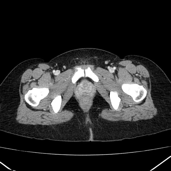 File:Ampullary tumor (Radiopaedia 22787-22816 C 71).jpg