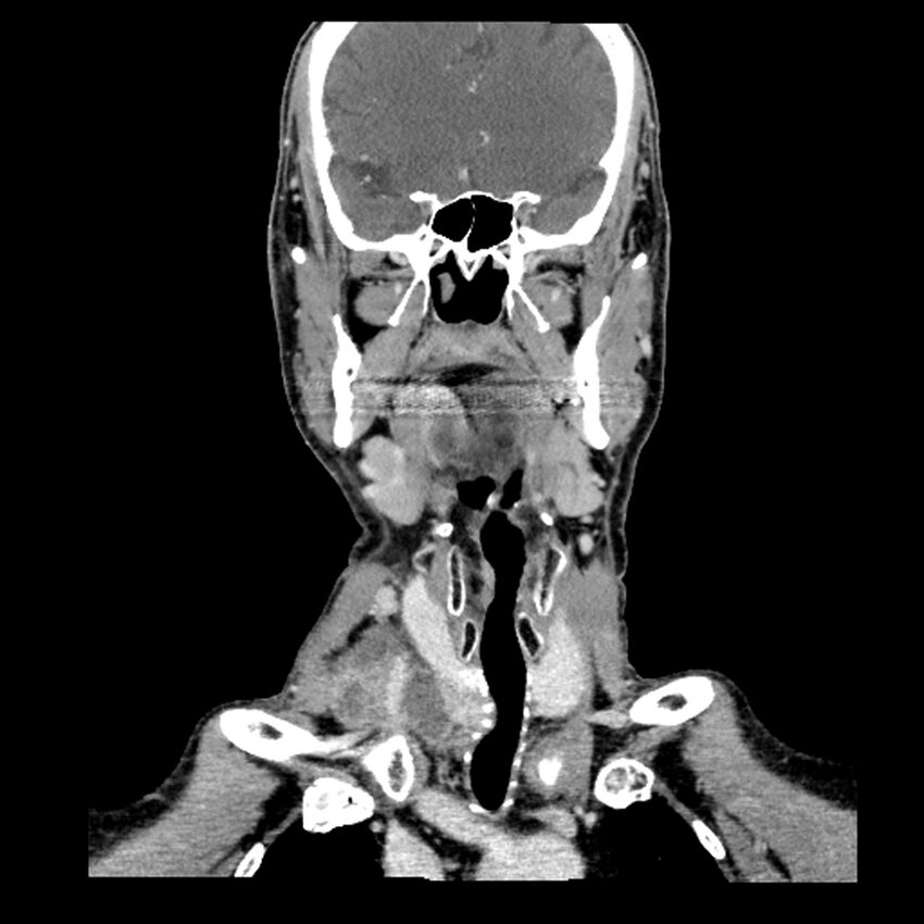 Anaplastic thyroid carcinoma (Radiopaedia 79087-92034 A 53).jpg