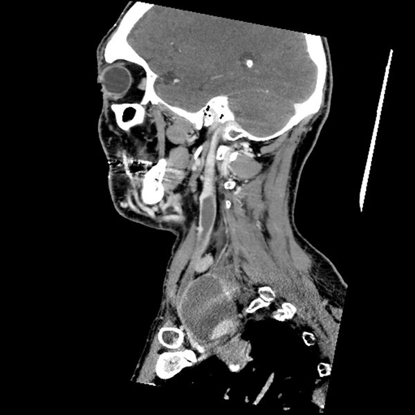 File:Anaplastic thyroid carcinoma (Radiopaedia 79087-92034 C 30).jpg