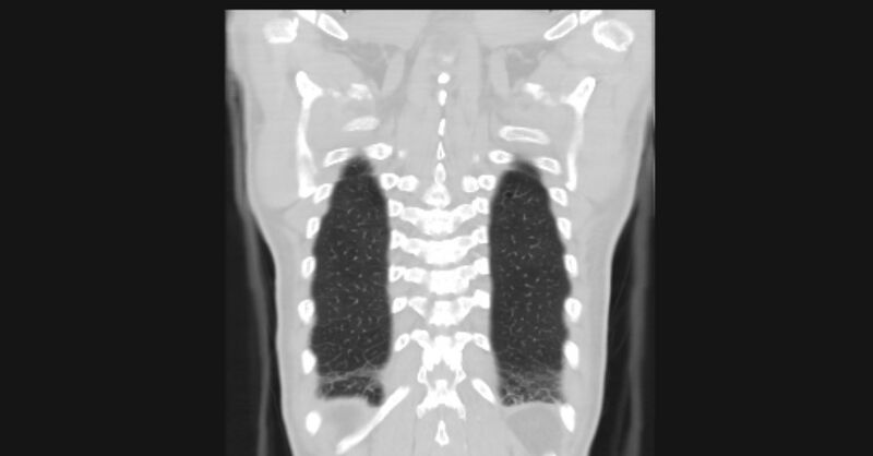 File:Angioinvasive aspergellosis (Radiopaedia 66995-76315 Coronal lung window 56).jpg