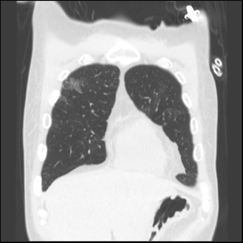 Angioinvasive aspergillosis (Radiopaedia 43957-47466 Coronal lung window 76).jpg