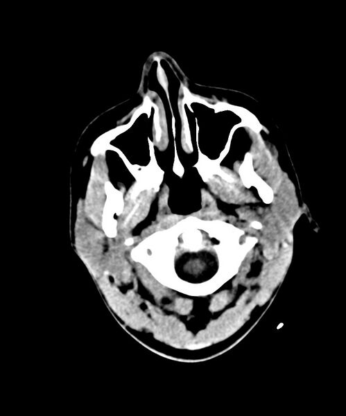 File:Angiomatous meningioma (Radiopaedia 79459-92578 Axial non-contrast 1).jpg