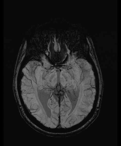 File:Angiomatous meningioma (Radiopaedia 79459-92579 E 30).jpg