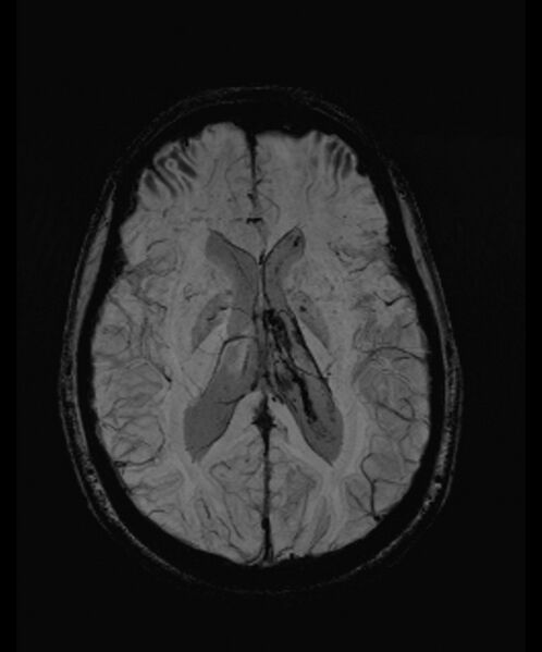 File:Angiomatous meningioma (Radiopaedia 79459-92579 E 36).jpg
