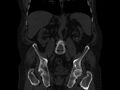 Ankylosing spondylitis (Radiopaedia 44609-48357 Coronal bone window 42).jpg