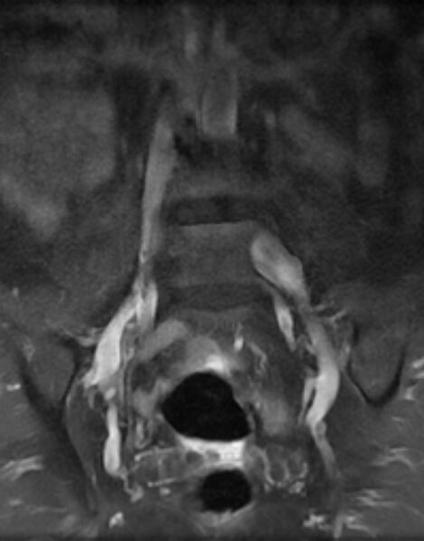 File:Ankylosing spondylitis - Andersson lesion (Radiopaedia 81878-95838 H 3).jpg