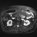 Annular pancreas (Radiopaedia 38292-40320 Axial T2 fat sat 21).png