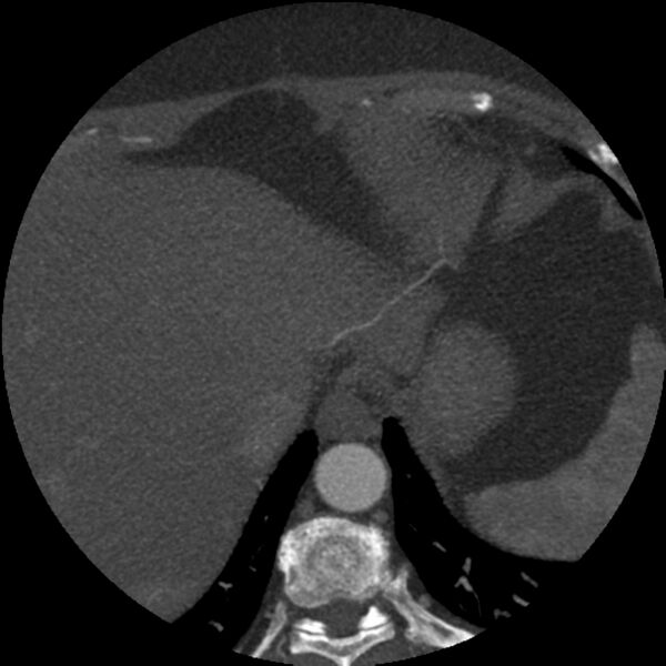 File:Anomalous origin of left circumflex artery from right coronary sinus (Radiopaedia 72563-83117 A 1).jpg