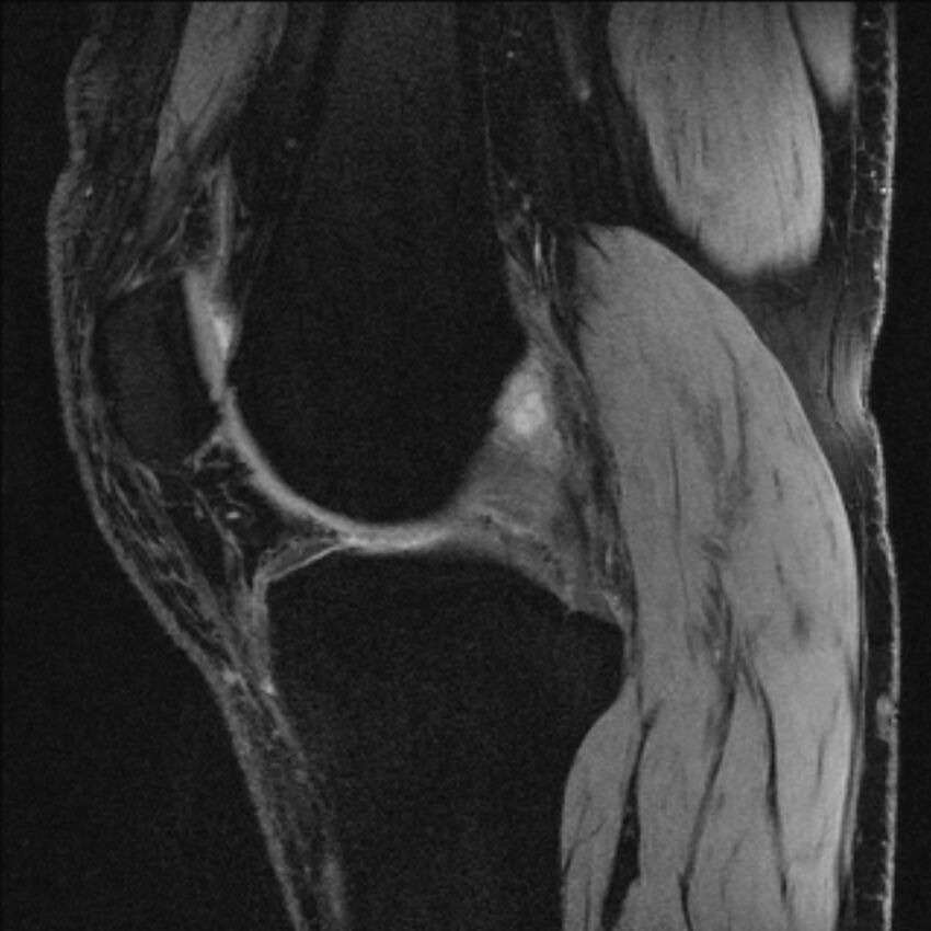 Anterior cruciate ligament mucoid degeneration (Radiopaedia 68400-77933 Sagittal 38).jpg