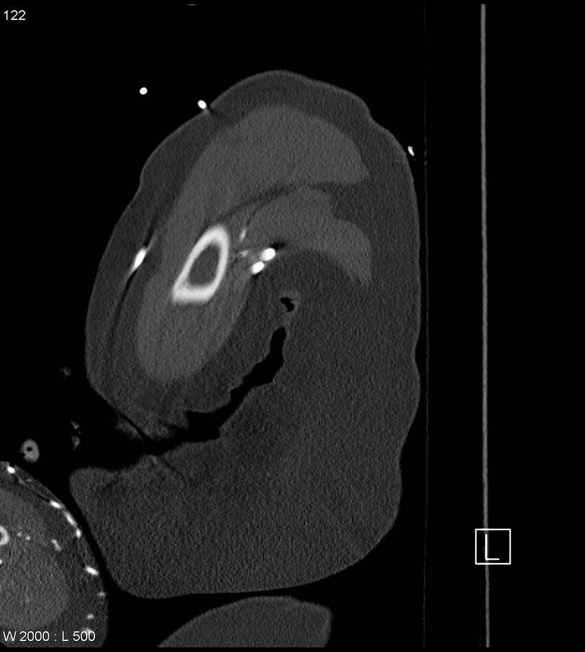 Anterior shoulder dislocation (CT) (Radiopaedia 59032-66309 Sagittal bone window 61).jpg