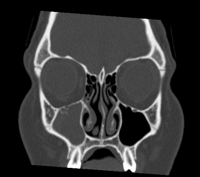 File:Antrochoanal polyp (Radiopaedia 21894-21868 Coronal bone window 9).jpg