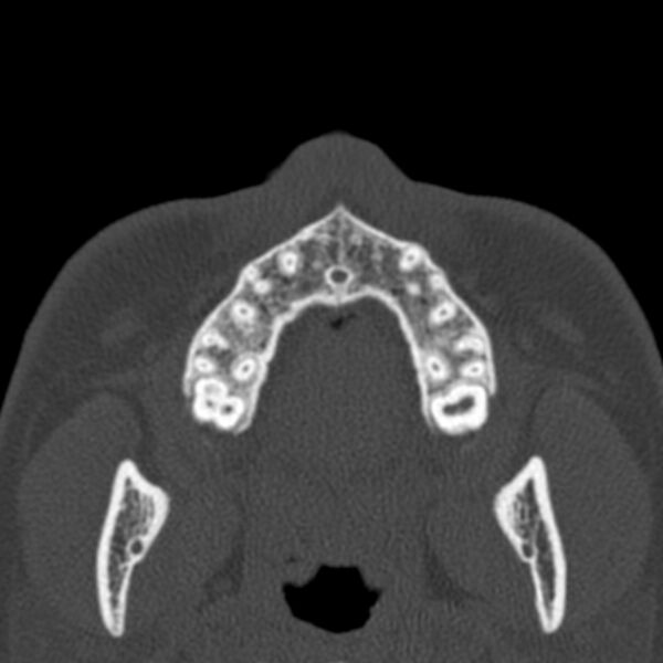 File:Antrochoanal polyp (Radiopaedia 33984-35202 Axial bone window 1).jpg