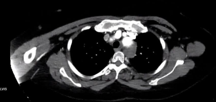 Aortic Dissection (Radiopaedia 85272-100847 A 11).jpg