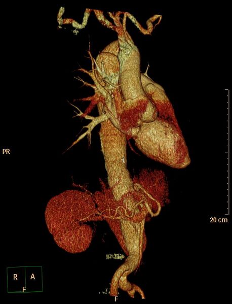 File:Aortic aneurysm and penetrating ulcer (Radiopaedia 23590-23704 3D reconstruction 5).jpg