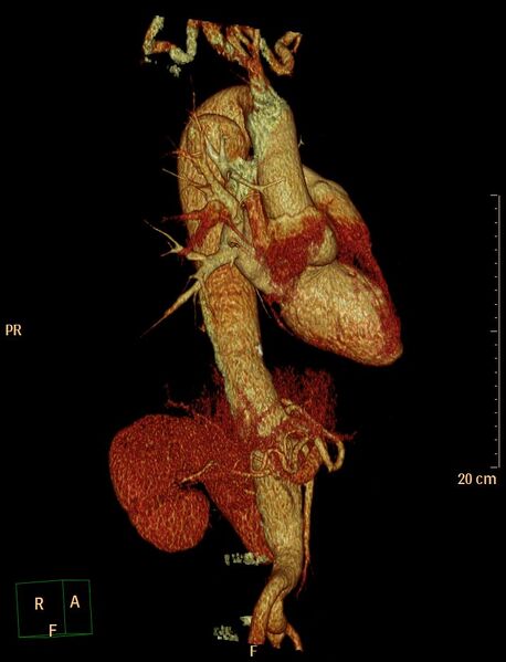 File:Aortic aneurysm and penetrating ulcer (Radiopaedia 23590-23704 3D reconstruction 6).jpg
