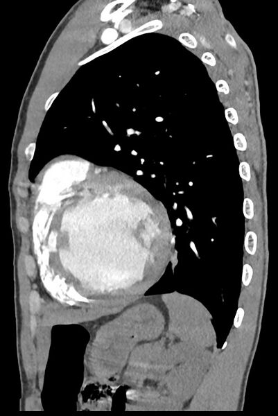 File:Aortic coarctation with aneurysm (Radiopaedia 74818-85828 B 116).jpg