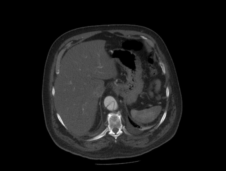File:Aortic dissection (Radiopaedia 28802-29105 A 39).jpg