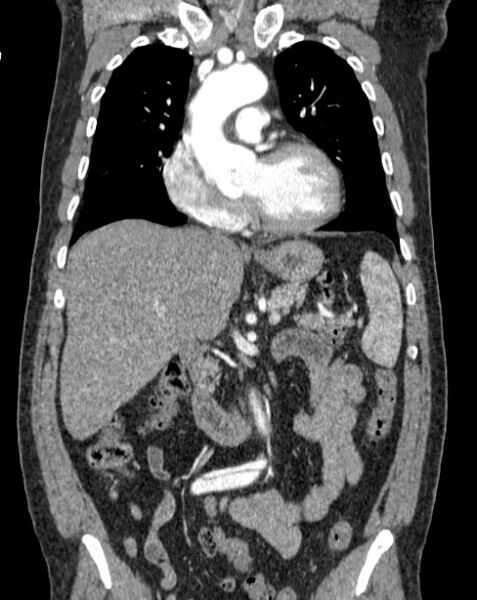 File:Aortic dissection (Radiopaedia 44411-48061 A 16).jpg