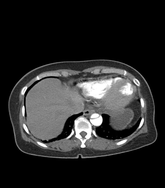 File:Aortic dissection with renal ischemia (Radiopaedia 76573-88338 A 53).jpg