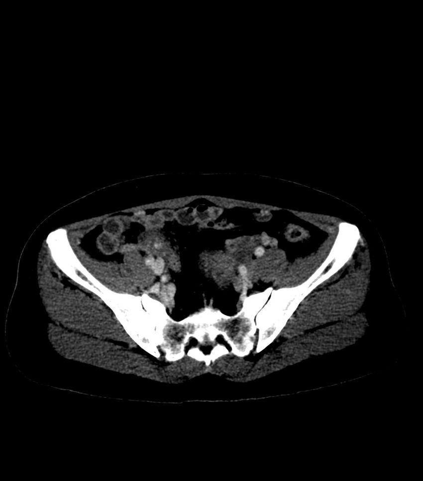 Aortic dissection with renal ischemia (Radiopaedia 76573-88338 B 53).jpg