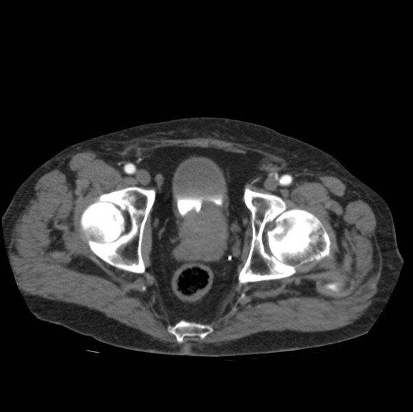 File:Aortic dissection with rupture into pericardium (Radiopaedia 12384-12647 A 86).jpg