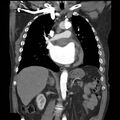 Aortic dissection with rupture into pericardium (Radiopaedia 12384-12647 B 21).jpg