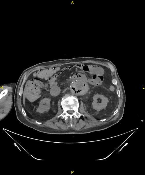File:Aortoenteric fistula (Radiopaedia 84308-99603 Axial non-contrast 144).jpg