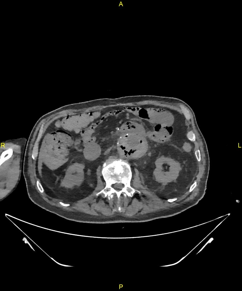 Aortoenteric fistula (Radiopaedia 84308-99603 Axial non-contrast 144).jpg