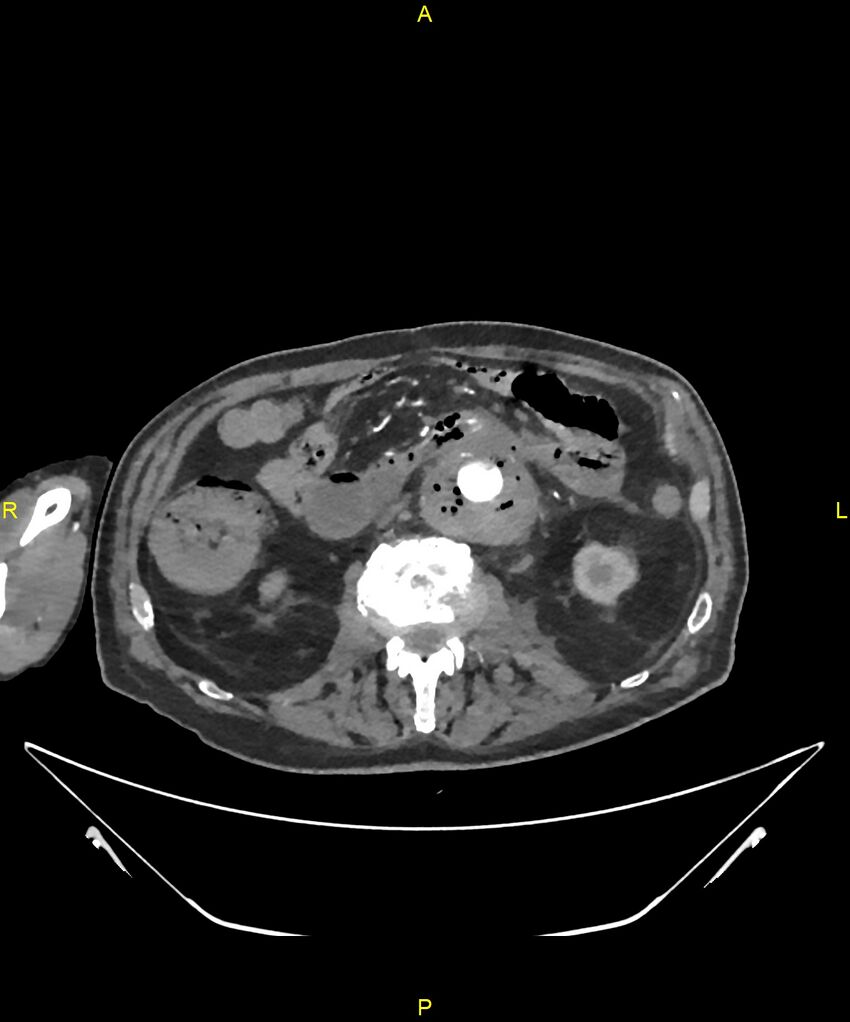 Aortoenteric fistula (Radiopaedia 84308-99603 B 165).jpg
