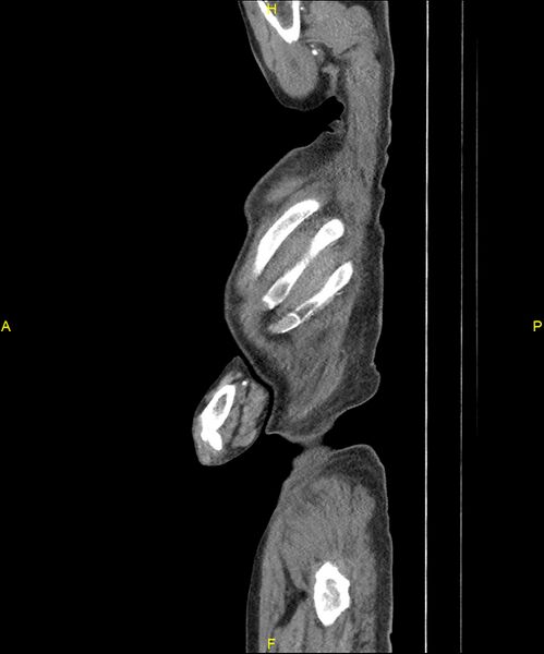 File:Aortoenteric fistula (Radiopaedia 84308-99603 C 18).jpg