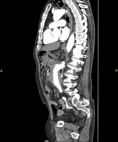 File:Aortoenteric fistula (Radiopaedia 84308-99603 C 197).jpg